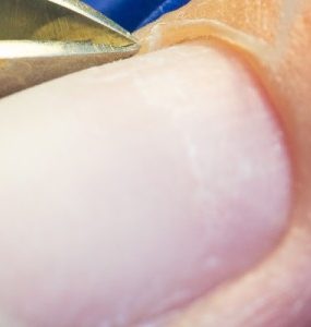 hard skin around nails
