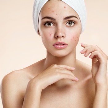does rosehip oil make your skin purge