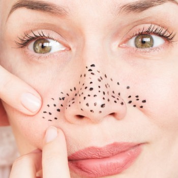 what happens to blackheads if you leave them