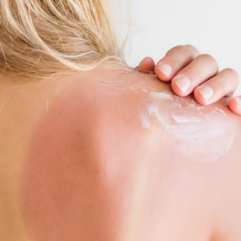 why do sunburn get worse at night